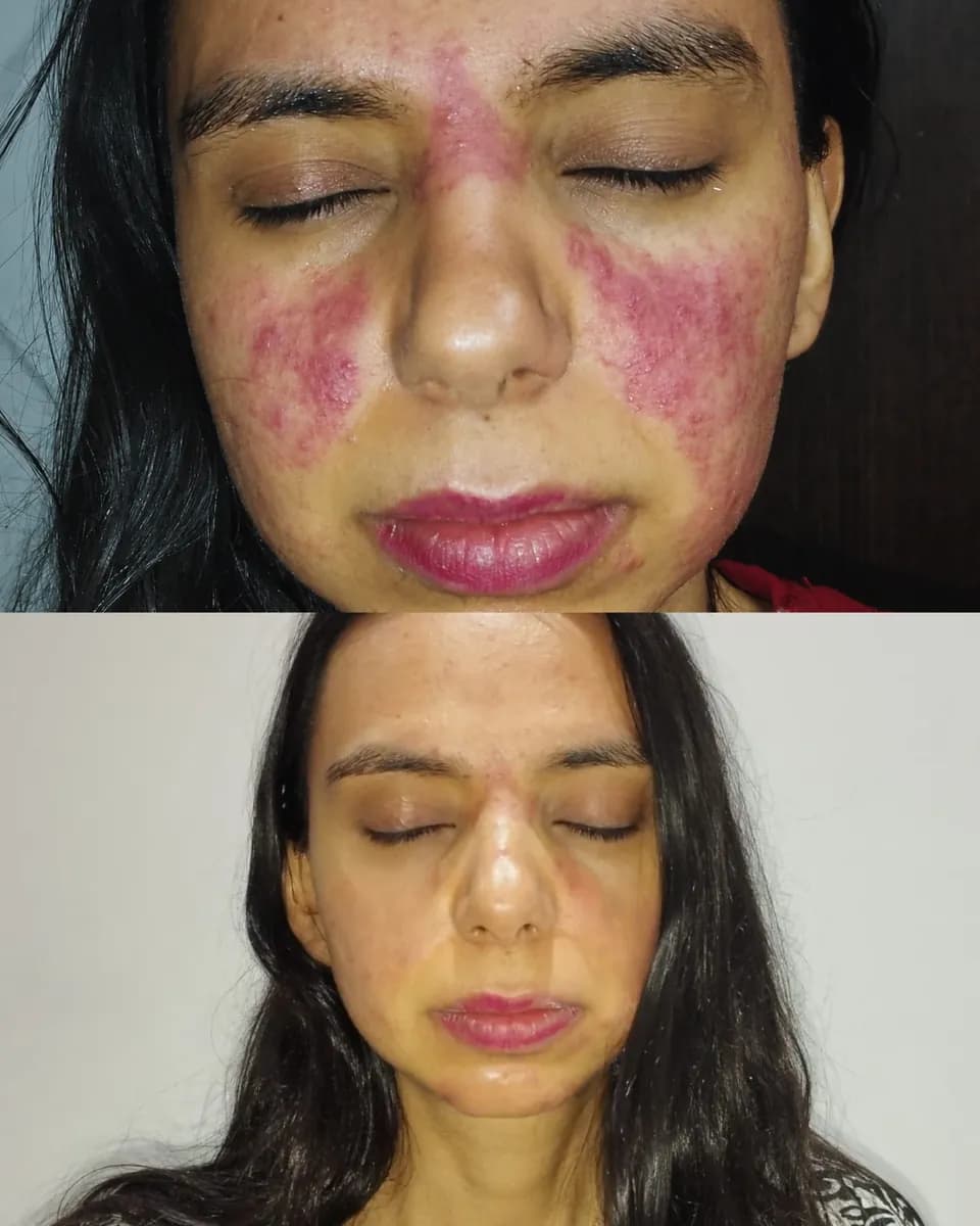Comparación del antes y después de Jessica con rojeces visibles en el rostro