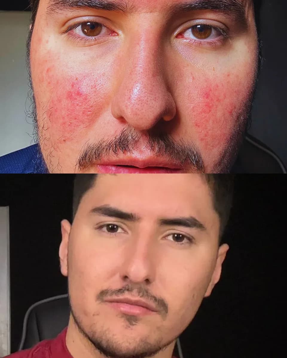 Comparación del antes y después de Andrés con rojeces visibles en las mejillas