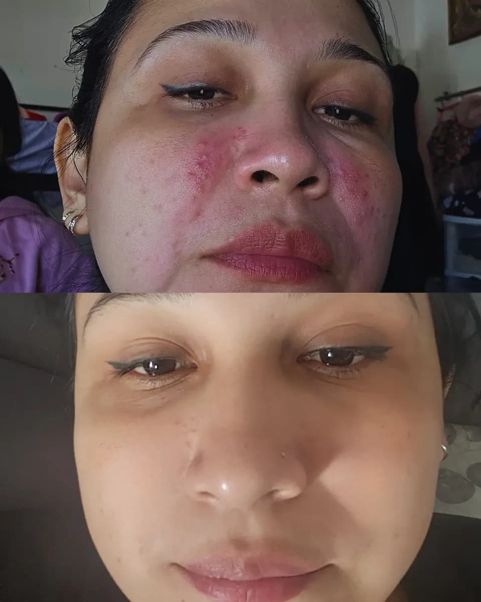 Comparación del antes y después de Camila con rojeces y brotes visibles en el rostro